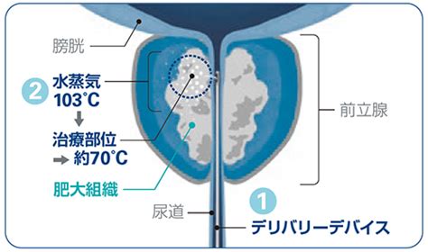 牛 ペニス|尿道結石による尿閉に対する陰茎温存手術の検討 